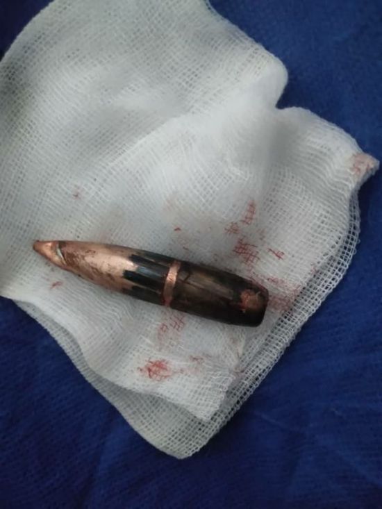 بعيار 12.7.. إنقاذ سيدة قنصتها مليشيا الحوثي بحيفان