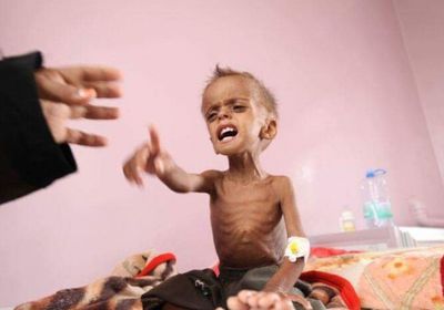 سوء التغذية في اليمن.. وباء حوثي تستأصله السعودية