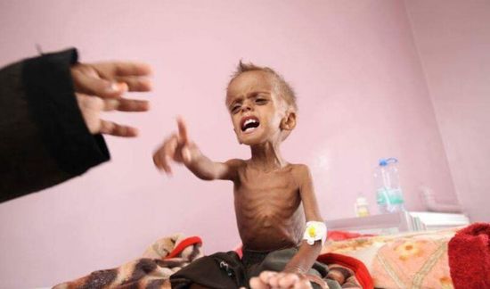 سوء التغذية في اليمن.. وباء حوثي تستأصله السعودية