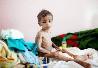 الموت يخطف طفلا لسوء التغذية في مسيمير لحج  