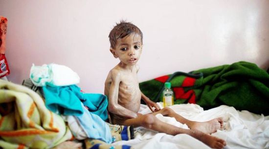 الموت يخطف طفلا لسوء التغذية في مسيمير لحج  