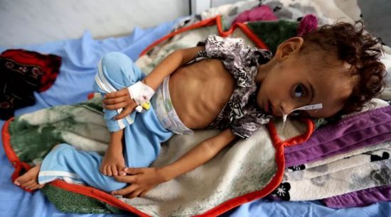 سوء التغذية.. رصاص حوثي غادر يخترق صدور الأطفال
