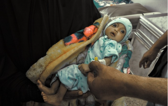 الصحة العالمية: فحص 102 ألف طفل يعانون سوء التغذية في عام