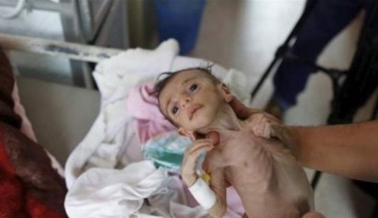 سوء التغذية.. السرطان الحوثي يفترس بطون الأطفال