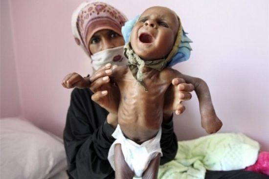 المشروعات الأممية في اليمن.. جهود دولية لسد رمق الجوعى
