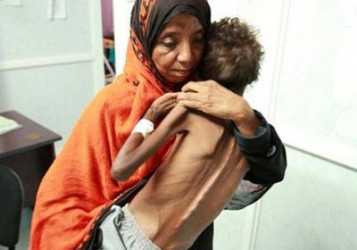  أطفال اليمن وسوء التغذية.. حرب حوثية لم تخلُ من المآسي