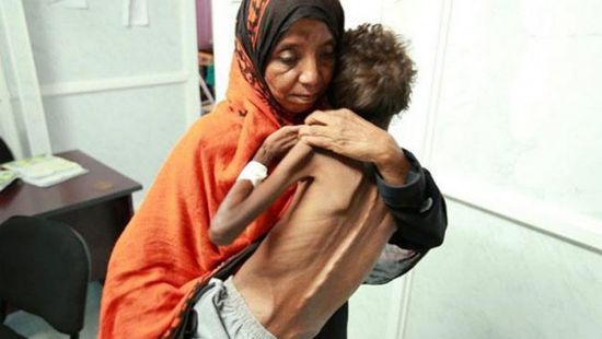  أطفال اليمن وسوء التغذية.. حرب حوثية لم تخلُ من المآسي
