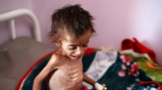 أغذية العيد.. جهود دولية لمواجهة مجاعة الحرب الحوثية