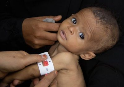 الغذاء العالمي: معدلات سوء التغذية في اليمن الأعلى بالعالم