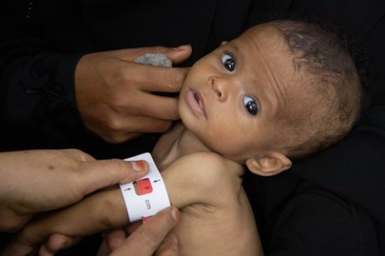 الغذاء العالمي: معدلات سوء التغذية في اليمن الأعلى بالعالم
