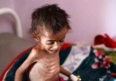 سوء التغذية في اليمن.. غول الحوثي الذي يلتهم السكان