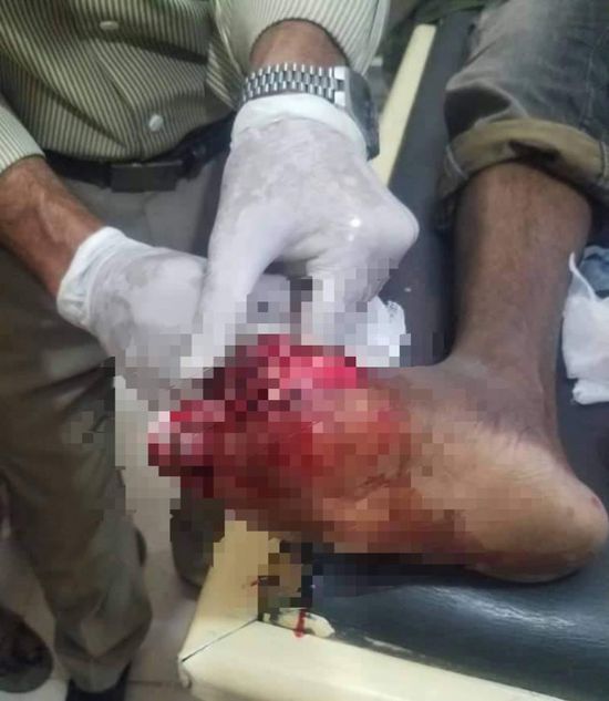 ضحية ثانية لبراميل القمامة "المتفجرة" في تعز