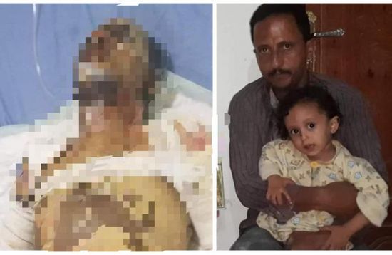 بعد محاولة نازح الانتحار حرقًا.. نذر غضب تلوح في إب