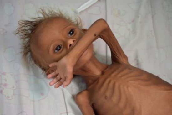  مجاعة اليمن.. كثرت التحذيرات والوجع واحد