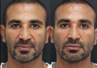 أول رد لـ أحمد سعد على إجرائه عملية تجميل وتغيير وجهه