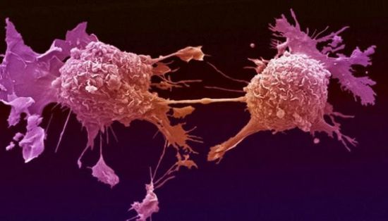 ابتكار مادة تزيد فاعلية العلاج الكيميائي لسرطان الرحم