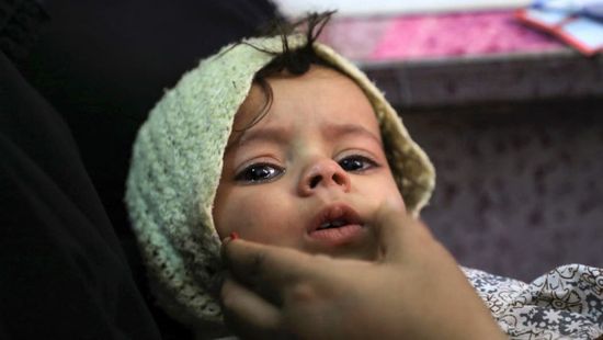 شلل الأطفال في اليمن.. داءٌ أفشاه الحوثيون