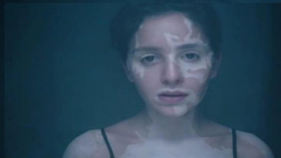 "مأساة الفتيات مع البهاق".. جميلة عوض تتحدث عن دورها في "إلا انا"