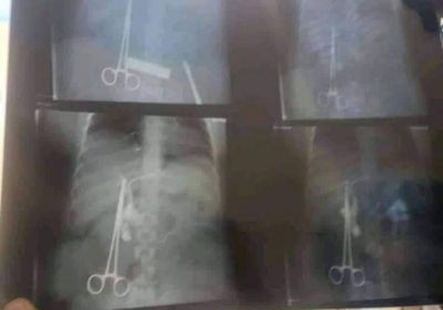 تعتيم حوثي على واقعة إهمال طبي بإب