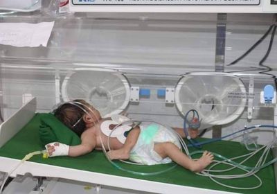 فريق طبي يشرف على حالة الطفل السيامي بحضرموت