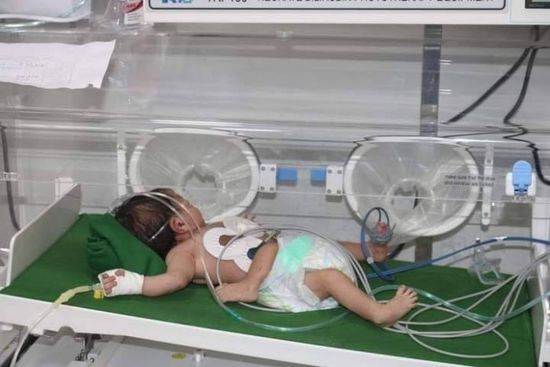 فريق طبي يشرف على حالة الطفل السيامي بحضرموت