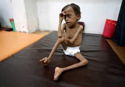 "مركز الملك سلمان".. مظلة إنسانية تنتشل أطفال اليمن من سوء التغذية