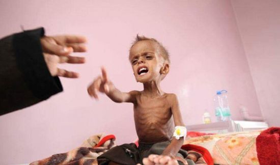 سوء التغذية.. غول فتاك صنعته الحرب الحوثية