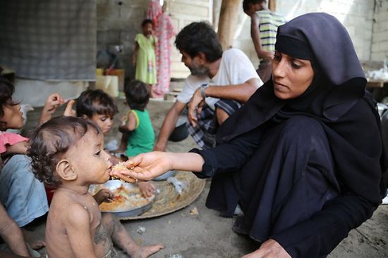 سوء التغذية في اليمن.. غول متوحش صنعه الحوثي والشرعية