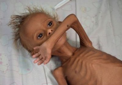 الجوع في اليمن.. وجه البطون الذي صنعه الحوثيون