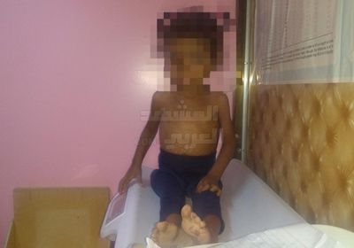 رصد طفلة مصابة بسوء تغذية وخيم في تبن