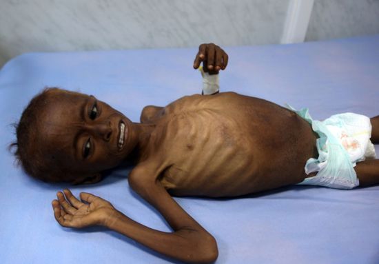  مواجهة سوء التغذية.. خطوة على طريق اليمن "الصعب"