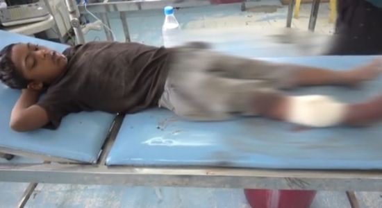 بالفيديو.. نيران حوثية تصيب طفلًا بهجوم على حيس