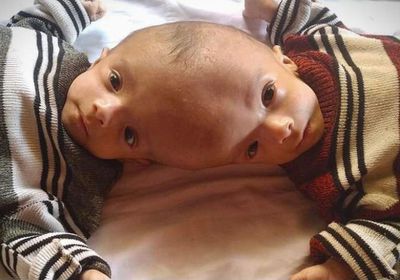 أوامر ملكية بنقل التوأمين السياميين "يوسف وياسين" للرياض