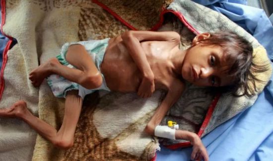 الجرائم الحوثية.. كيف تفاقم أعباء الجوع والفقر؟