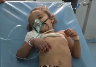 شاهد.. رصاص الحوثيين يهشم عظام طفلة في حيس