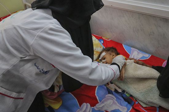 الصحة العالمية: إنقاذ 7682 طفلًا من سوء التغذية