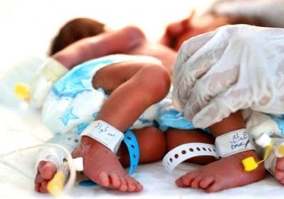 ولادة توأم سيامي في صنعاء