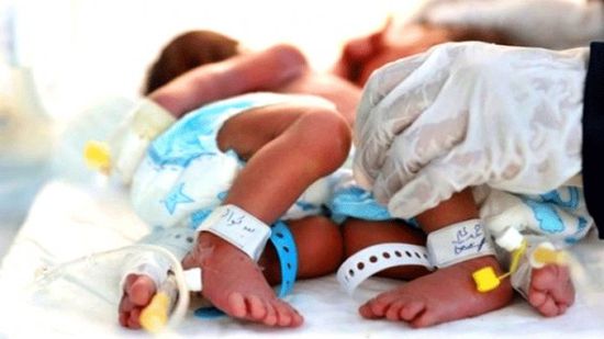 ولادة توأم سيامي في صنعاء