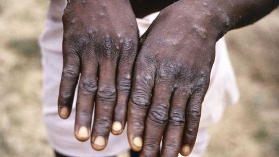  للاشتباه بإصابتهم بجدري القرود.. البحث عن 200 شخص في أمريكا