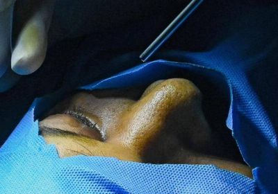 الفطر الأسود يظهر مجددًا في العراق