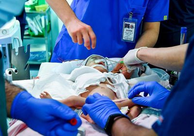 25 طبيبًا سعوديًا يبدأون فصل التوأم السيامي