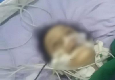 الإهمال الطبي في إب.. من ولادة طبيعية لانفجار بالرحم والأمعاء