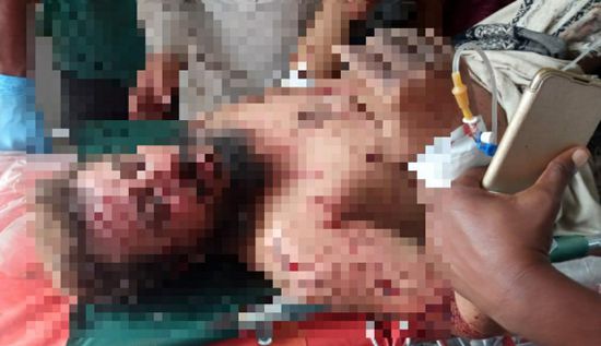 إصابة عامل نزع ألغام بجروح خطرة في الملاح