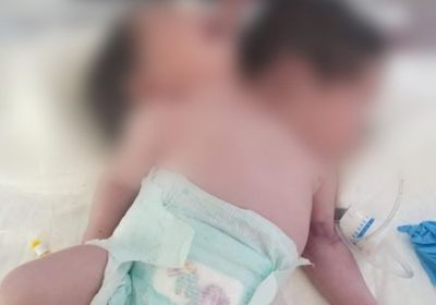 ولادة توأم سيامي في مستشفى بصنعاء 