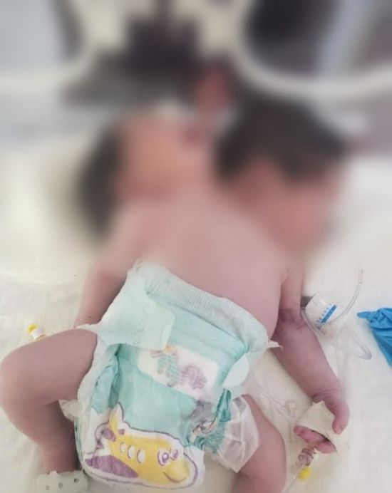ولادة توأم سيامي في مستشفى بصنعاء 