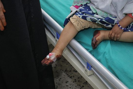 الصحة العالمية تدبر أدوية لمرضى الثلاسيميا في اليمن