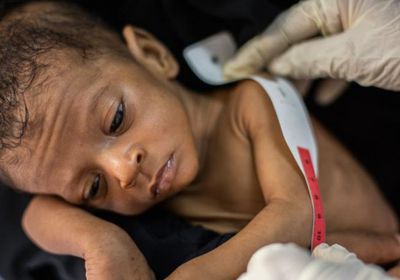 يونيسف: 45% من أطفال اليمن يعانون التقزم