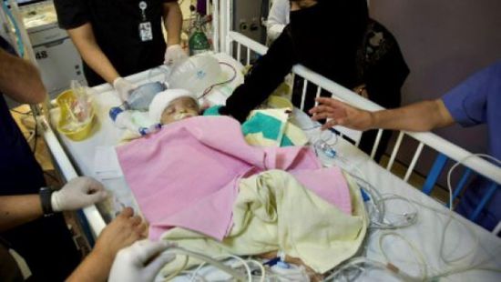 بمشاركة 24 خبيرا.. نجاح عملية فصل التوأم يوسف وياسين