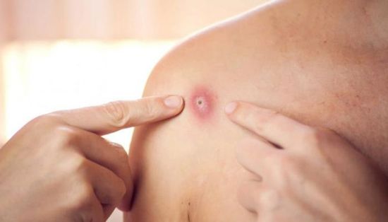 رصد أول إصابة بجدري القرود في ألمانيا