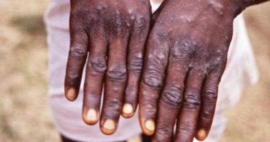 أول تحرك عالمي لمواجهة مرض "جدري القردة"